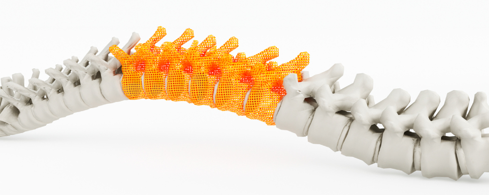Can 3D Printing Revolutionize Spinal Implants?